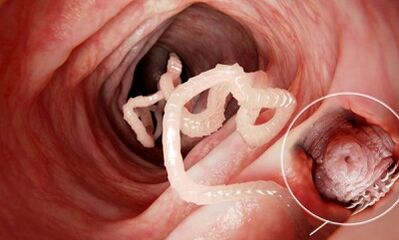 how to recognize the presence of parasites in the human intestines